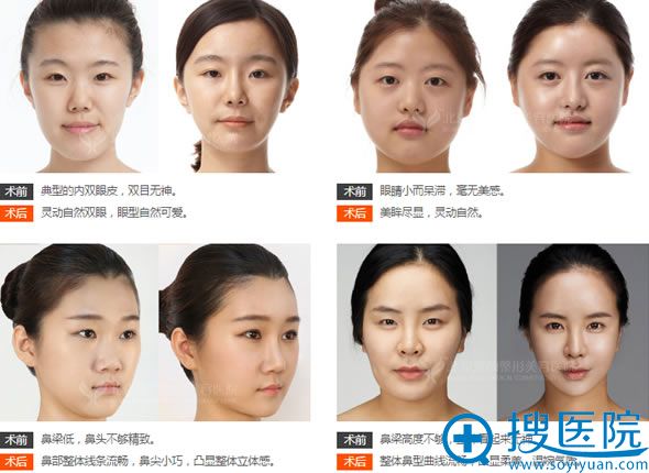<!--<i data=20240710 data-id=13212></i>-->王海南教授五官整形案例 <!--<i data=20240710 data-id=13212></i>-->王海南教授五官整形案例