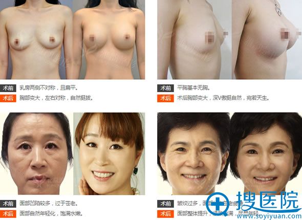 <!--<i data=20240710 data-id=13212></i>-->王海南教授自体脂肪填充案例 <!--<i data=20240710 data-id=13212></i>-->王海南教授自体脂肪填充案例