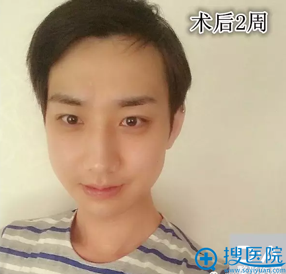 地包天改善术后两周效果 地包天改善术后两周效果