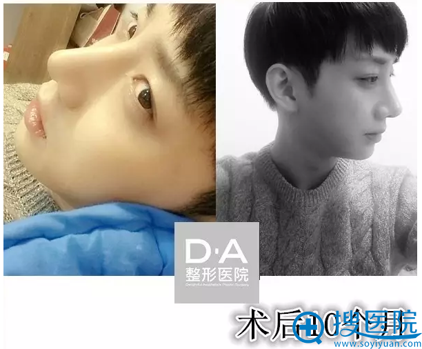 韩国DA整形医院两颚+隆鼻术后10个月效果图 韩国DA整形医院两颚+隆鼻术后10个月效果图