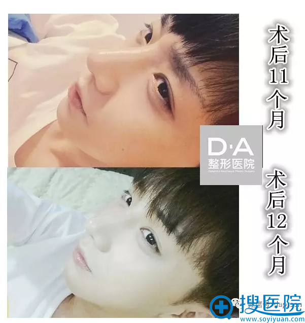 韩国DA整形医院两颚+隆鼻术后1年生活照 韩国DA整形医院两颚+隆鼻术后1年生活照
