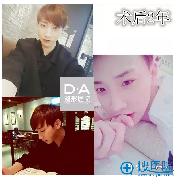 韩国DA整形医院两颚+隆鼻术后2年自拍 韩国DA整形医院两颚+隆鼻术后2年自拍