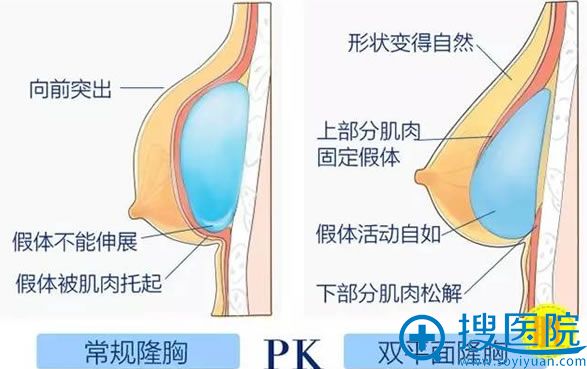 内窥镜假体隆胸的优势 内窥镜假体隆胸的优势