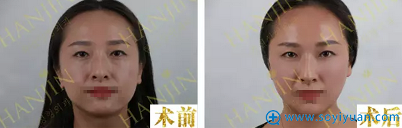 昆明韩辰玻尿酸注射+线雕提升效果对比照 昆明韩辰玻尿酸注射+线雕提升效果对比照