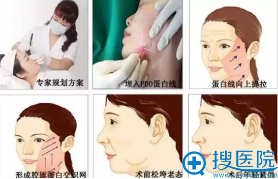 昆明韩辰线雕技术怎么样?玻尿酸注射+埋线提升视频案例告诉你