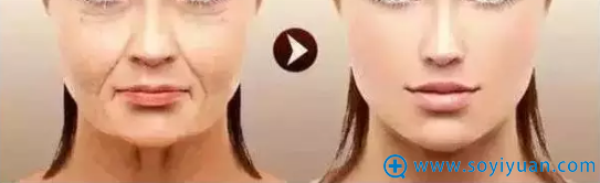 线雕治疗效果示意图 线雕治疗效果示意图