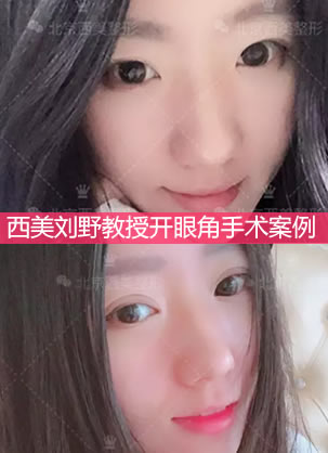 内双怎么变外双?妹子在西美医院刘野教授的帮助下实现大眼梦