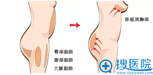 上海时光做填充怎么样 张晶医生自体脂肪隆胸案例过程图大揭秘