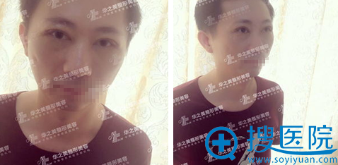 全切双眼皮+上睑提肌术术后三天恢复效果 全切双眼皮+上睑提肌术术后三天恢复效果