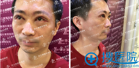 <!--<i data=20240710 data-id=11996></i>-->汪波宇院长全切双眼皮拆线后效果 <!--<i data=20240710 data-id=11996></i>-->汪波宇院长全切双眼皮拆线后效果