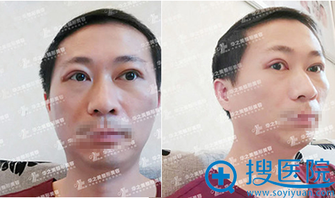 汪波宇全切双眼皮+上睑提肌术术后15天效果 汪波宇全切双眼皮+上睑提肌术术后15天效果