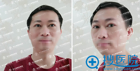 <!--<i data=20240710 data-id=11996></i>-->汪波宇院长全切双眼皮术后2个月恢复照 <!--<i data=20240710 data-id=11996></i>-->汪波宇院长全切双眼皮术后2个月恢复照