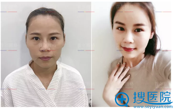 刚在上海首尔丽格做完自体脂肪填充全脸术后5天恢复过程图分享