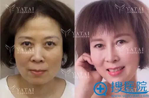 <!--<i data=20240710 data-id=9828></i>-->整形线雕除皱案例 <!--<i data=20240710 data-id=9828></i>-->整形线雕除皱案例