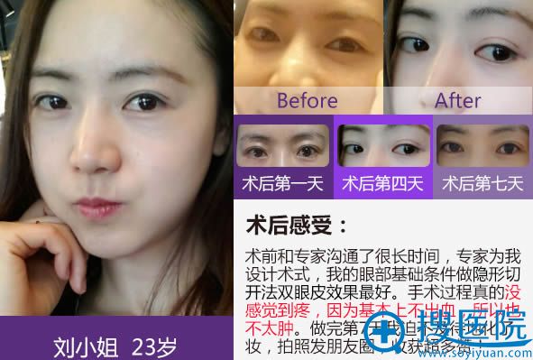 杨荣华切开双眼皮前后对比案例 杨荣华切开双眼皮前后对比案例