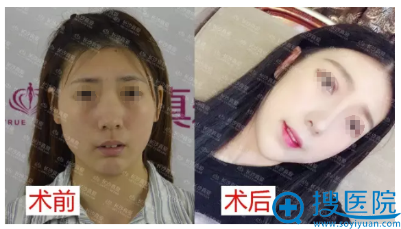 看我找长沙真爱医疗整形美容医院李瑶做的鼻综合案例效果怎么样