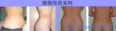 <!--<i data=20240710 data-id=2609></i>-->激光整形美容医院吸脂案例 <!--<i data=20240710 data-id=2609></i>-->激光整形美容医院吸脂案例