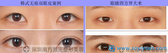 <!--<i data=20240710 data-id=2609></i>-->激光整形美容医院眼部整形案例 <!--<i data=20240710 data-id=2609></i>-->激光整形美容医院眼部整形案例