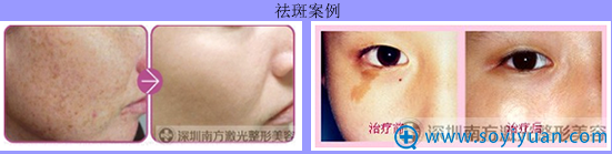 <!--<i data=20240710 data-id=2609></i>-->激光整形美容医院祛斑案例 <!--<i data=20240710 data-id=2609></i>-->激光整形美容医院祛斑案例