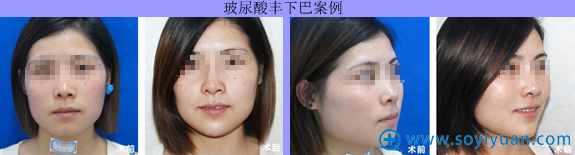南方激光整形美容医院玻尿酸丰下巴案例 南方激光整形美容医院玻尿酸丰下巴案例