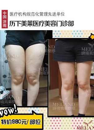 济南美莱门诊部大腿+腰腹部射频分层吸脂前后对比效果展示