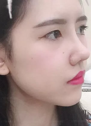 广州海峡鼻综合案例:膨体隆鼻+鼻基底缩窄术真实恢复期图片