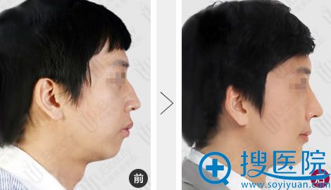 沈绍勇教授鹰钩鼻矫正案例 沈绍勇教授鹰钩鼻矫正案例