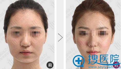 广州华美沈绍勇隆鼻前后对比效果 广州华美沈绍勇隆鼻前后对比效果