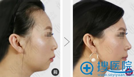 广州华美美容医院做鼻子前后对比照 广州华美美容医院做鼻子前后对比照
