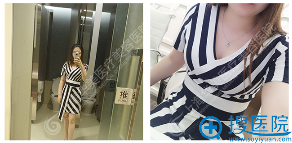 这是在华美做完吸脂一个月左右的照片 这是在华美做完吸脂一个月左右的照片