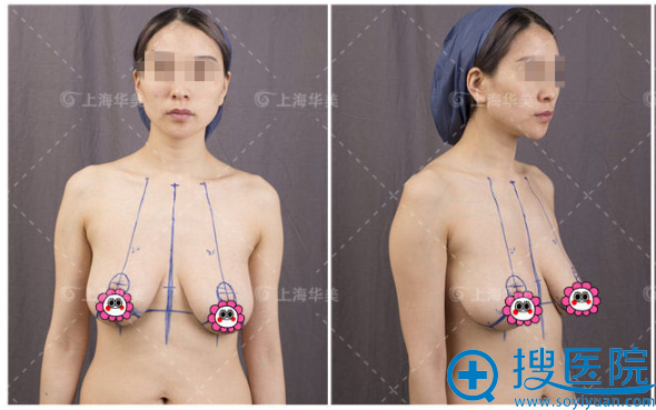 乳房下垂怎么办?上海华美李健乳房悬吊提升术后恢复图片分享