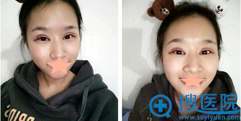 隋长清全切双眼皮+开眼角术后2天 隋长清全切双眼皮+开眼角术后2天