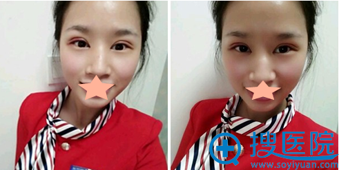 福州海峡隋长清全切双眼皮术后4天恢复效果 福州海峡隋长清全切双眼皮术后4天恢复效果