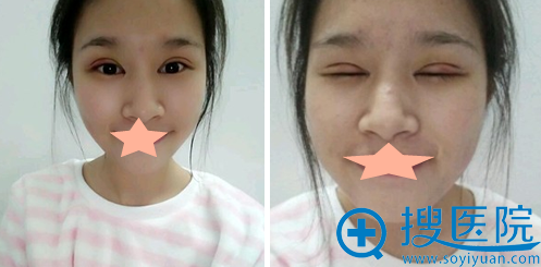 隋长清全切双眼皮5天睁眼闭眼效果 隋长清全切双眼皮5天睁眼闭眼效果