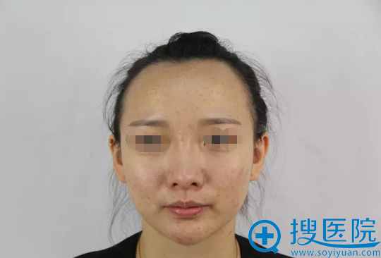 对比昆明韩辰和华美美莱的案例价格后找洪晓娅做了鼻综合隆鼻
