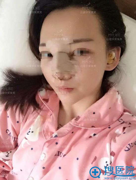 <!--<i data=20240710 data-id=5560></i>-->美莱鼻综合术后天效果 <!--<i data=20240710 data-id=5560></i>-->美莱鼻综合术后天效果