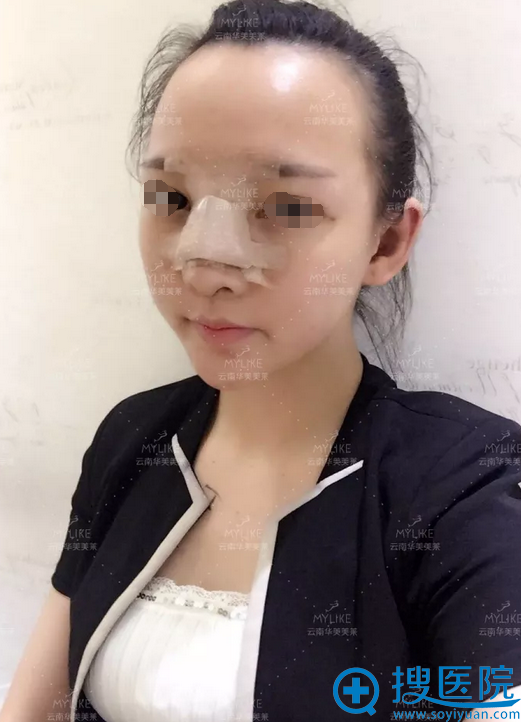 <!--<i data=20240710 data-id=5560></i>-->美莱鼻综合第5天恢复情况 <!--<i data=20240710 data-id=5560></i>-->美莱鼻综合第5天恢复情况