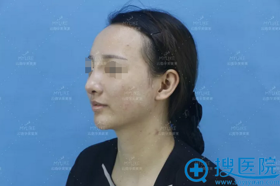 鼻综合7天拆线效果 鼻综合7天拆线效果