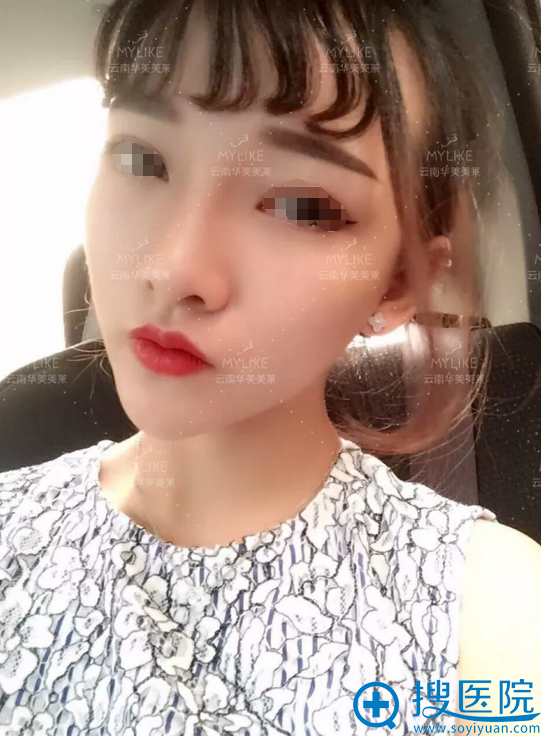 鼻综合术后第十天的样子 鼻综合术后第十天的样子