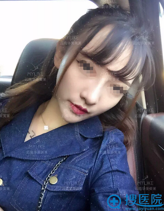 <!--<i data=20240710 data-id=5560></i>-->美莱<!--<i data=20240710 data-id=15879></i>-->做的鼻综合隆鼻真人案例图 <!--<i data=20240710 data-id=5560></i>-->美莱<!--<i data=20240710 data-id=15879></i>-->做的鼻综合隆鼻真人案例图