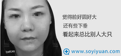 【案例】婴儿肥如何瘦脸?深圳香蜜丽格热拉提帮你解决问题