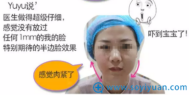 热拉提去婴儿肥半边脸治疗效果 热拉提去婴儿肥半边脸治疗效果