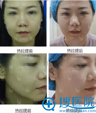 <!--<i data=20240710 data-id=15090></i>-->热拉提治疗效果前后对比 <!--<i data=20240710 data-id=15090></i>-->热拉提治疗效果前后对比