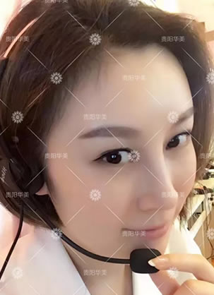 假体隆鼻失败后找贵阳华美金孝宪做鼻修复后收获了完美的自己