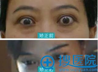 女企业家突眼矫正前后效果 女企业家突眼矫正前后效果