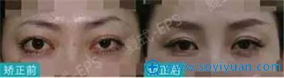 22岁女士做突眼矫正手术效果 22岁女士做突眼矫正手术效果