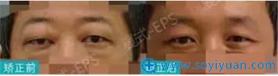 男性做矫正摆脱甲亢眼球突出烦恼 男性做矫正摆脱甲亢眼球突出烦恼