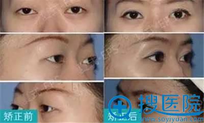 近视眼眼球突出矫正后的效果 近视眼眼球突出矫正后的效果