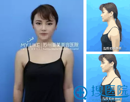 苏州美莱深V动感丰胸+内窥镜假体隆胸手术术后90天恢复过程图