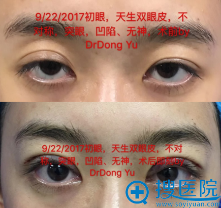<!--<i data=20240710 data-id=2340></i>--><!--<i data=20240710 data-id=16271></i>-->双眼皮失败修复案例 <!--<i data=20240710 data-id=2340></i>--><!--<i data=20240710 data-id=16271></i>-->双眼皮失败修复案例